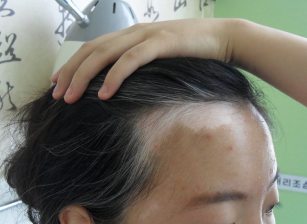 백반증 피부 변색