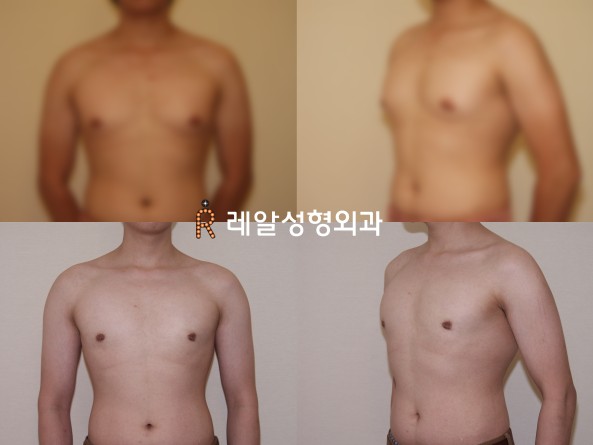 여유증 전 후