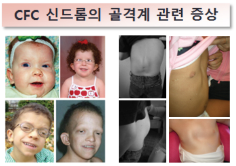 CFC 신드롬의 골격계 관련증상