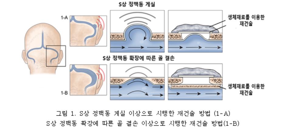 약업신문]박동성 이명, 귀 뒤 정맥 수술로 장기 치료 가능